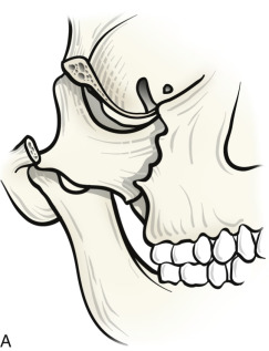 243x317 zygomatic nerve