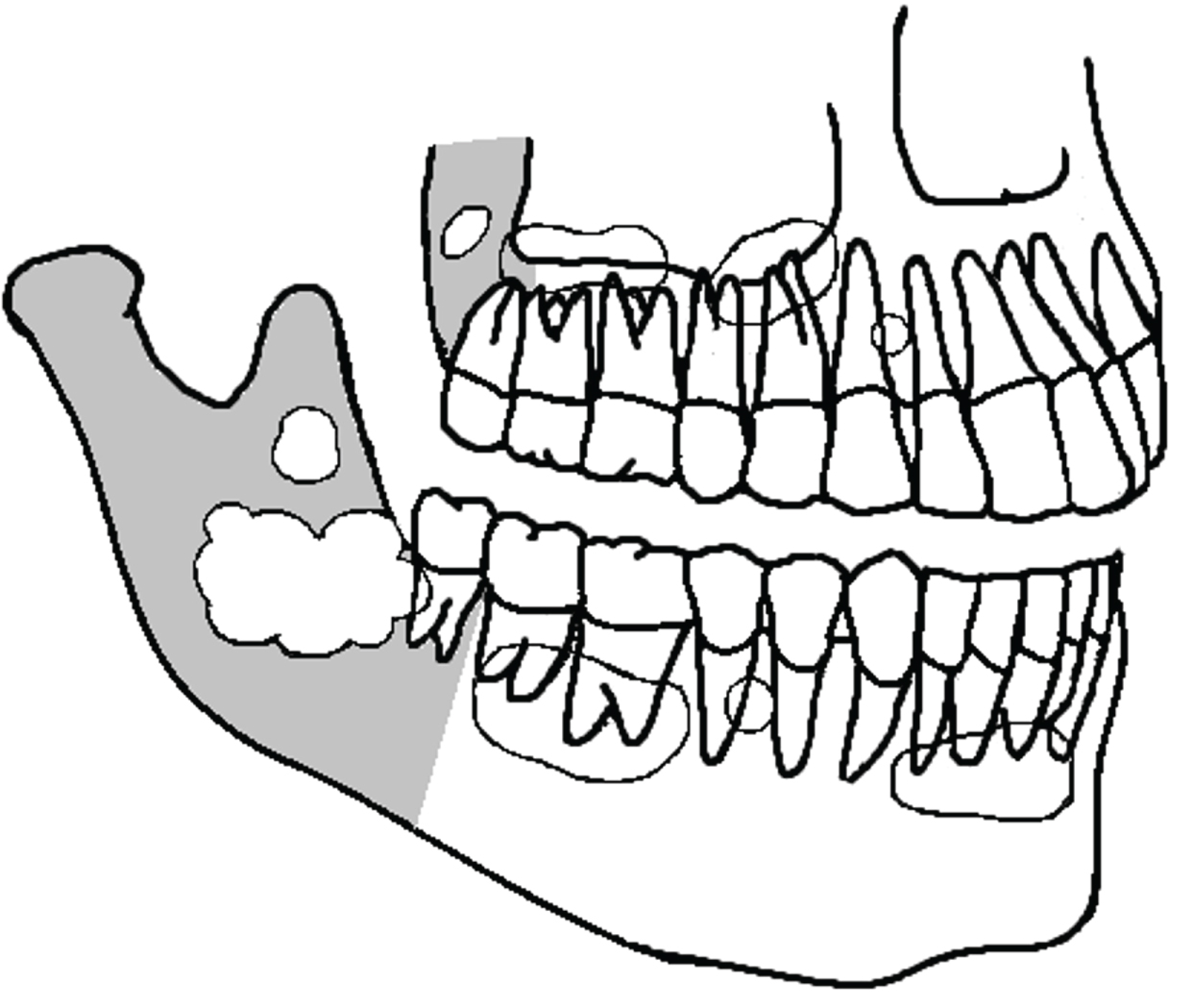 1241x1049 Conservative Treatment Of Primary And Nonsyndromic Odontogenic