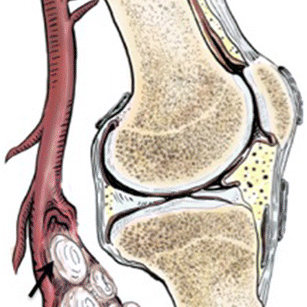 307x307 drawing showing cystic adventitial disease of the popliteal artery