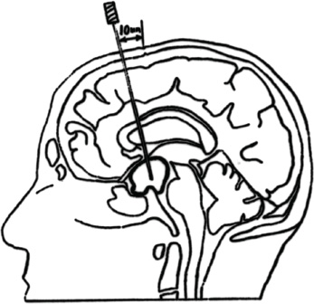 347x336 intracavitary radiation for cystic craniopharyngiomas neupsy key