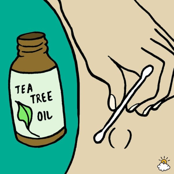 600x600 sebaceous cysts how to safely remove them at home