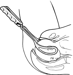 294x300 forceps delivery definition of forceps delivery