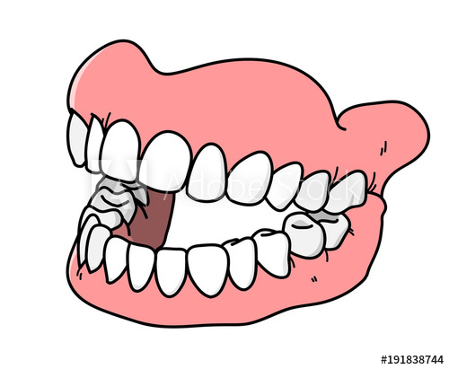500x411 Dental Prosthesis, A Hand Drawn Vector Cartoon Illustration