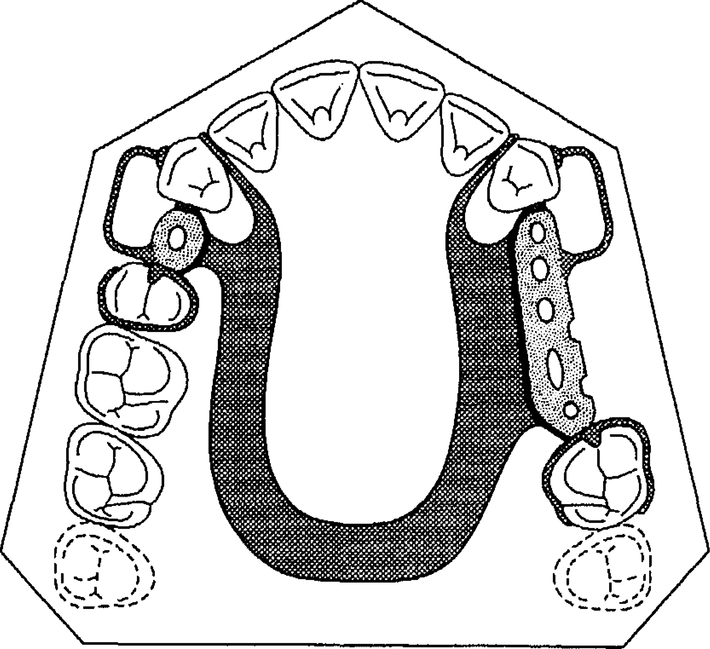 2314x2116 fit of direct retainers in removable partial dentures after