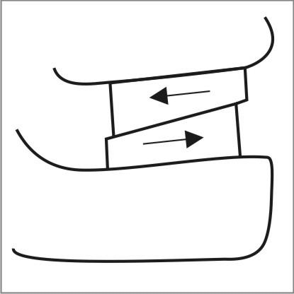 415x416 Shunting Effect From Tipped Occlusal Plane Download Scientific