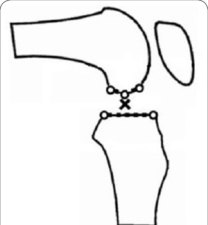 689x745 schematics of knee bones with point of contact determination five