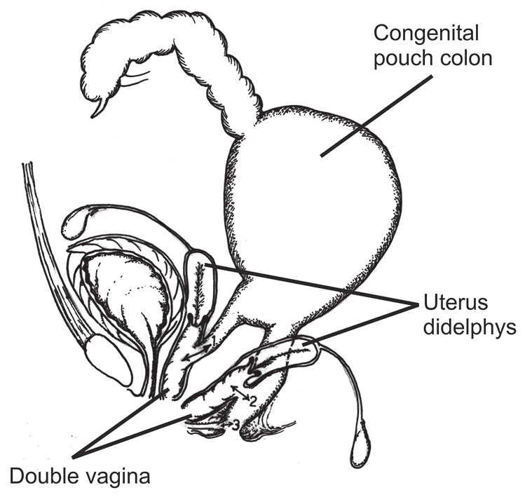 749x709 diagrammatic representation of the anatomy with triplet fi stula