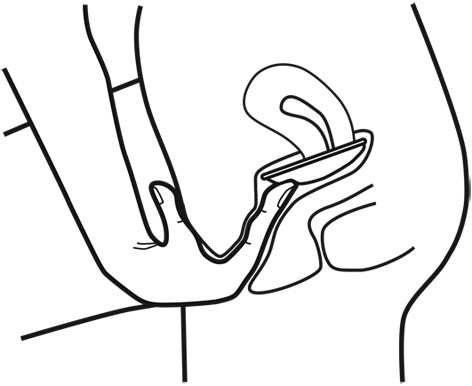 472x386 diaphragm insertion small