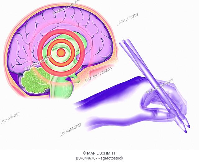 640x521 Drawing Illustration Of Parkinson Disease Stock Photos And Images