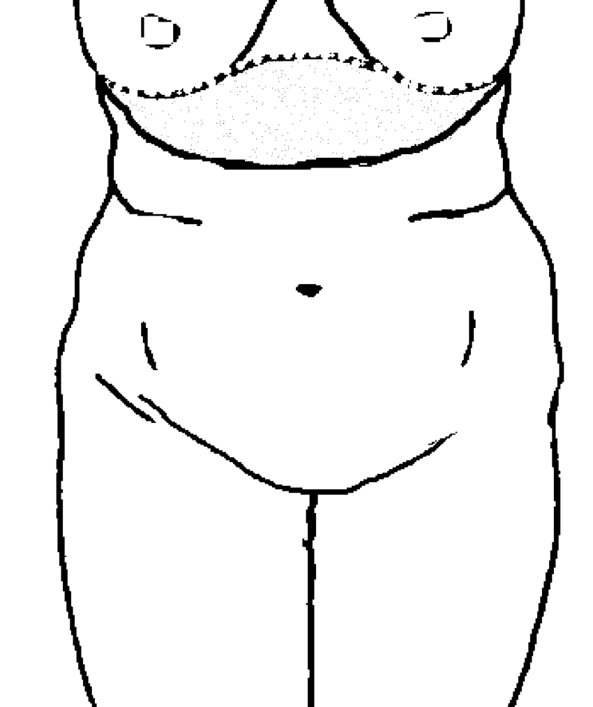850x1013 Schematic Drawing Of The Reverse Abdominoplasty The Dotted Line