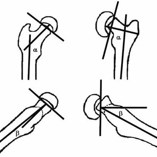 320x320 the head shaft angle on the ap view and the lateral head