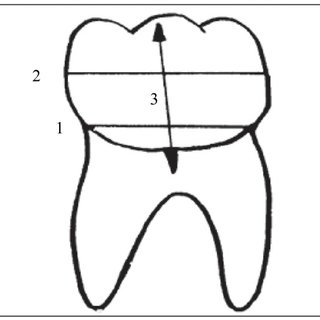 320x320 Drawing Of Occlusal Plane And Horizontal Line Of The Third Molar