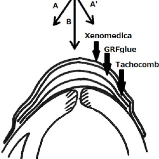 320x320 Schematic Drawing Of The Sutureless Repair Method Using Multiple