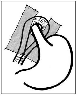 265x330 simple cruroplasty and sis mesh repair download scientific diagram
