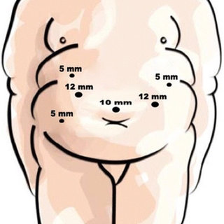 320x320 Sites For Trocar Placement In Laparoscopic One Anastomosis Gastric