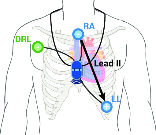 510x441 lead positioning of the ble ecg st schematic drawing