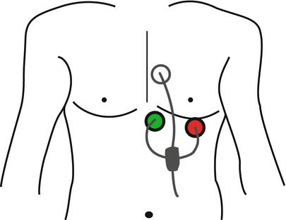405x312 principles of ecg gating for cmr springerlink