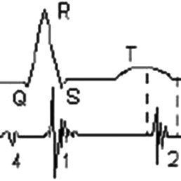 258x258 relationship between the heart sounds and the ecg waveform