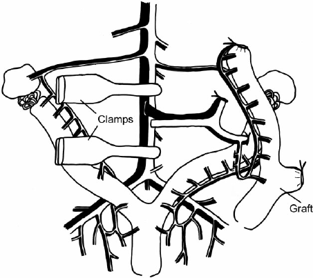 453x403 Schematic Drawing Showing Sites Of Hemostatic Clamps