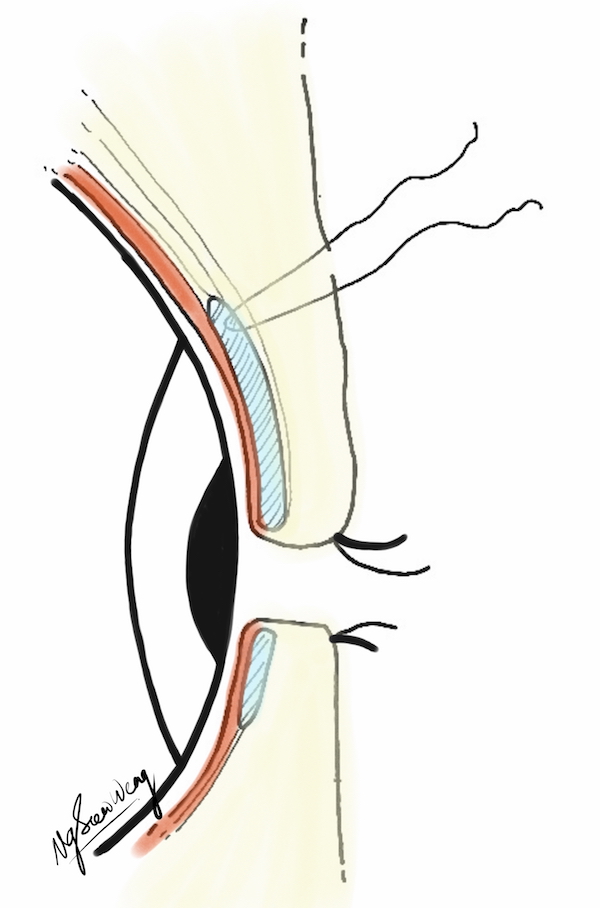 600x908 Double Eyelid Surgery In Singapore Blepharoplasty Best Practice