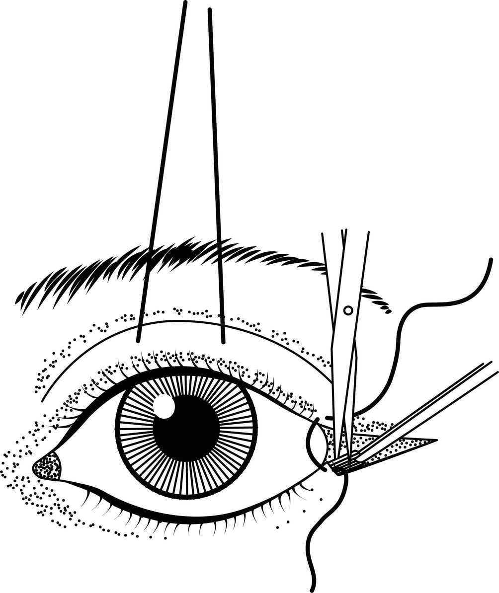 1004x1194 cheek midface lift springerlink