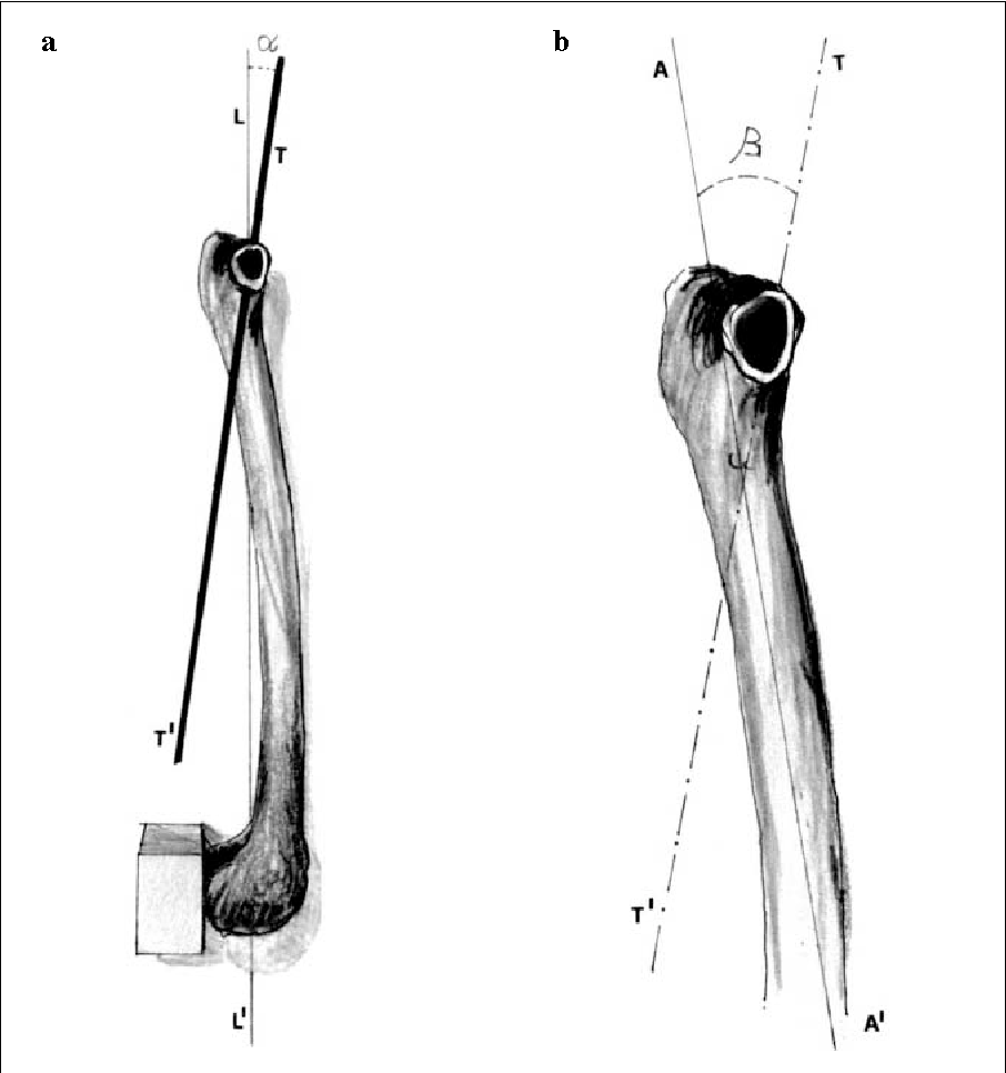 906x966 Figure From The Anatomy Of The Femoral Neck Variability