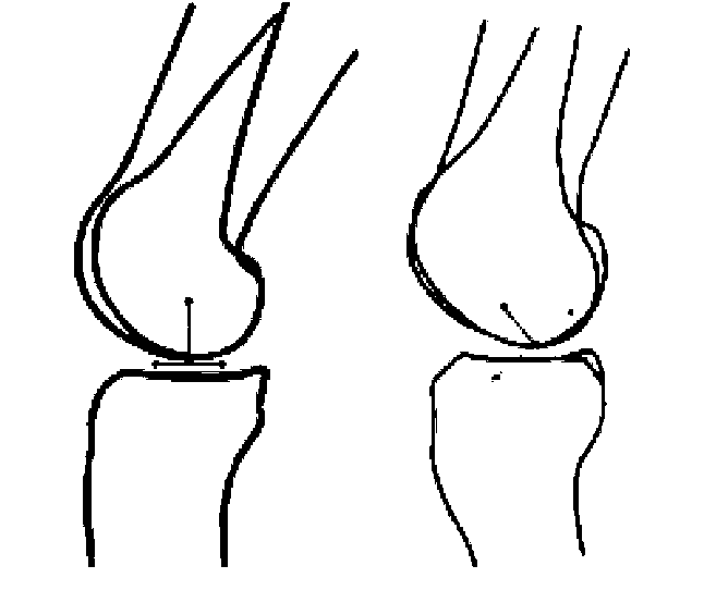 646x542 In Each Of These Images, Two Views Of The Femur Are Superimposed