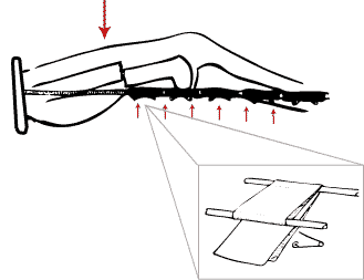 329x253 overview of traction techniques in orthopaedic surgery