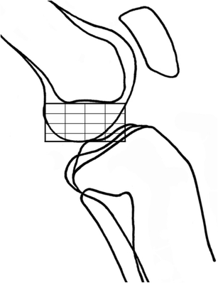 307x398 radiographic anatomy of the native anterior cruciate ligament