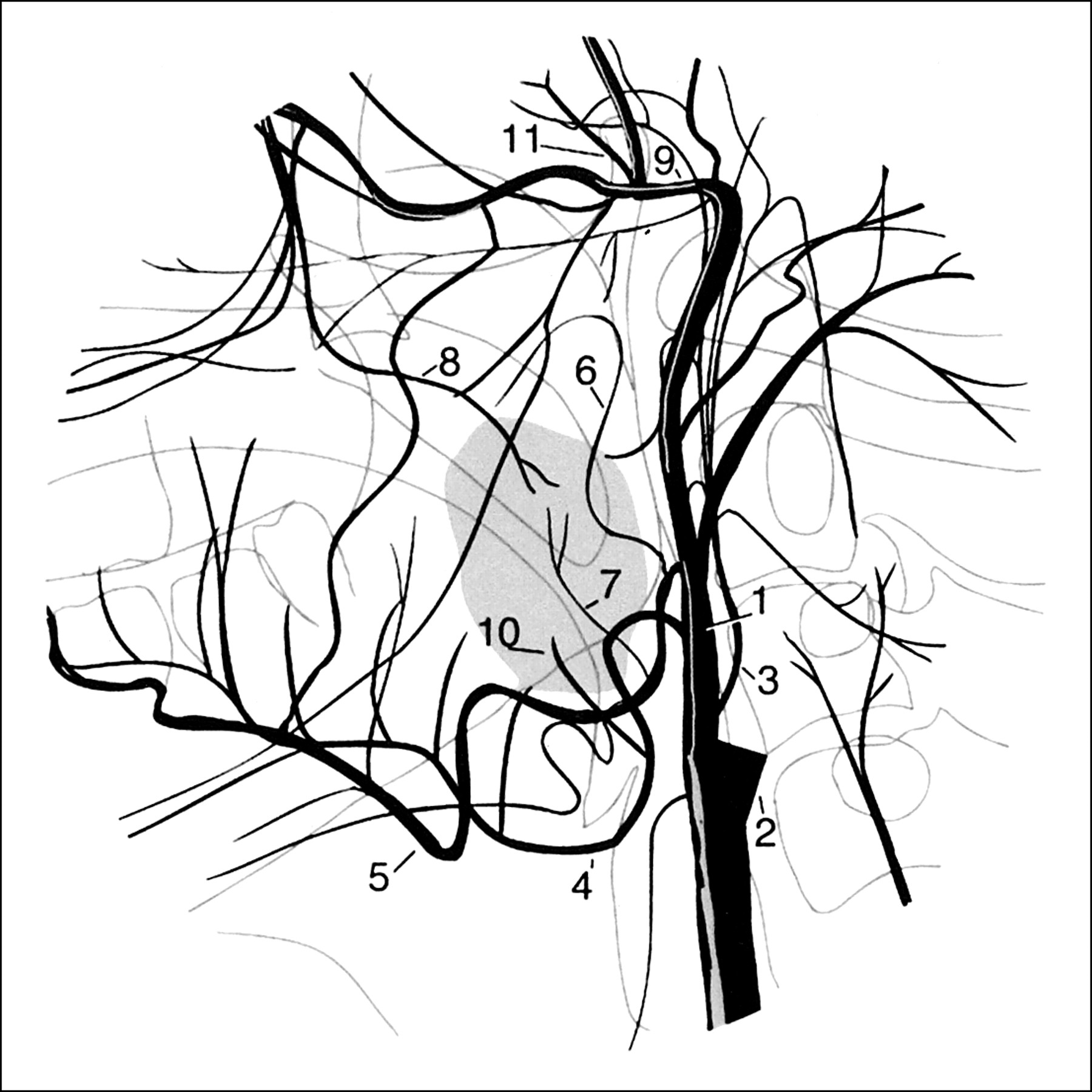 1800x1800 Fig Endovascular Treatment Of Hemorrhage After Tonsillectomy