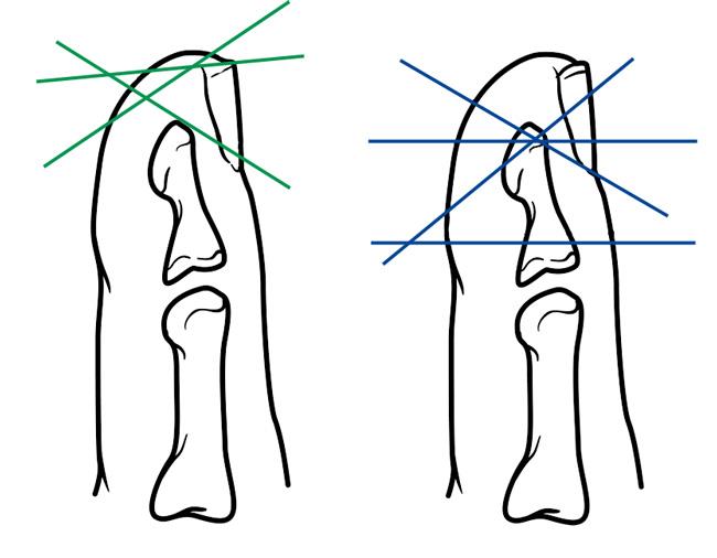 650x506 fingertip injuries and amputations