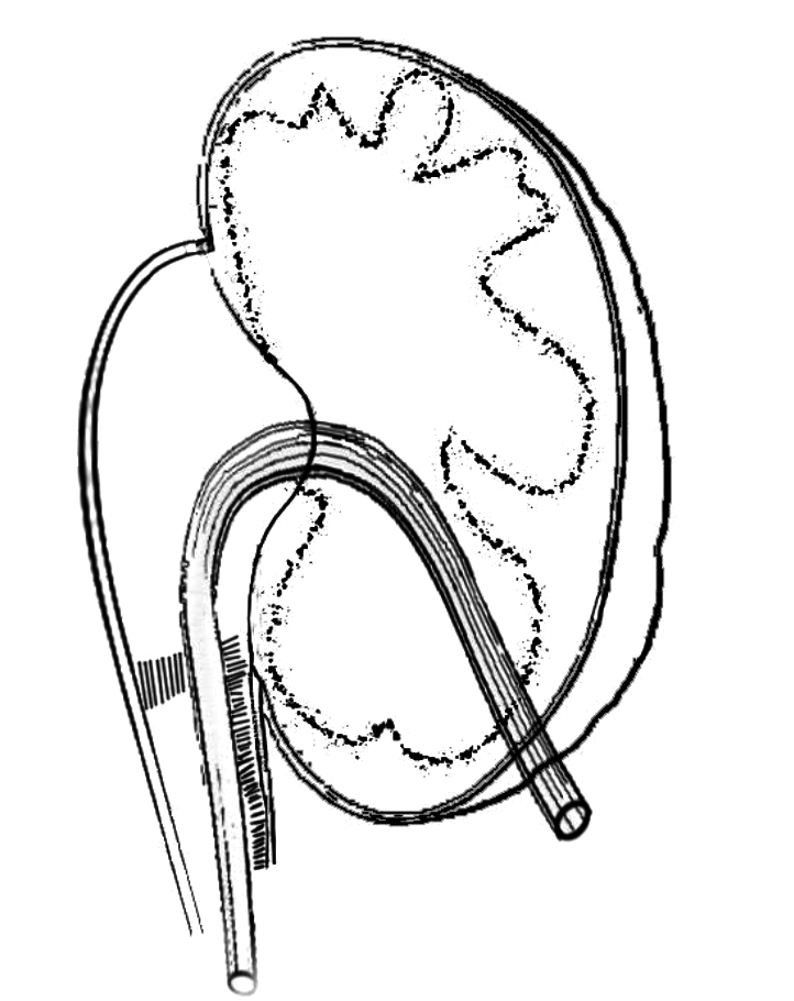 722x910 Schematic Diagram Of A Nephroureteral Catheter And Funnel Shaped