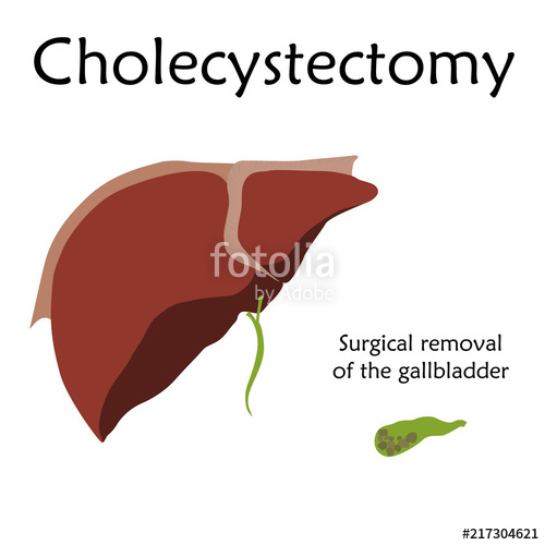 500x500 gallbladder disease treatment, surgery, cholecystectomy