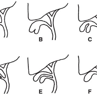 320x320 boyden classification of congenital duplication of the gallbladder