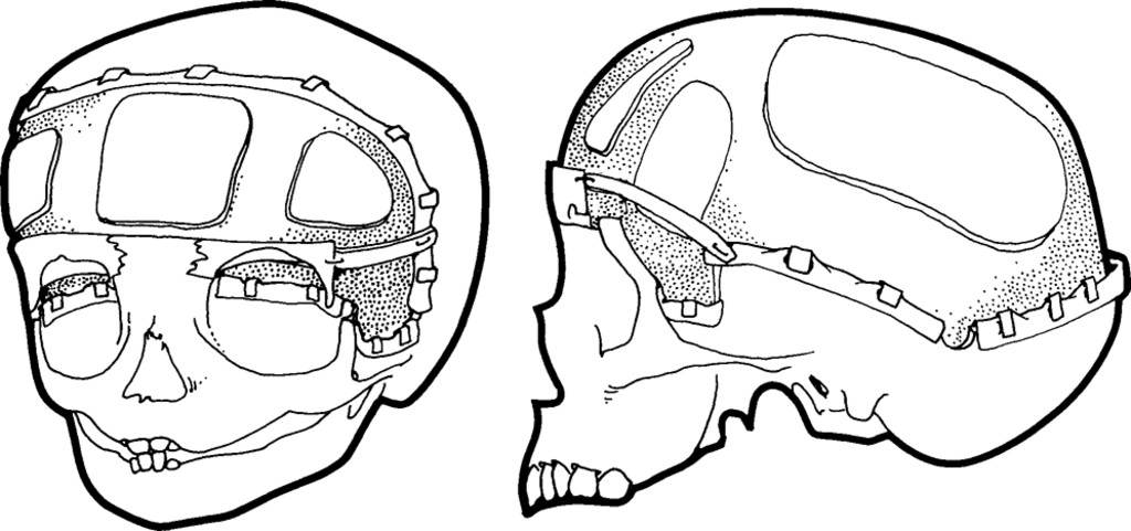 1024x481 Early Neurosurgical Repair In Craniofacial Dysmorphism In Journal