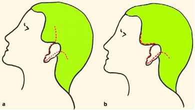 390x221 Plane Of Undermining And Incision Lines