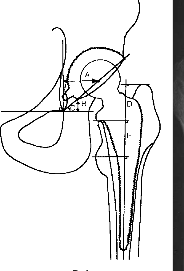 598x880 The Metal Cancellous Cementless Total Hip Arthroplasty