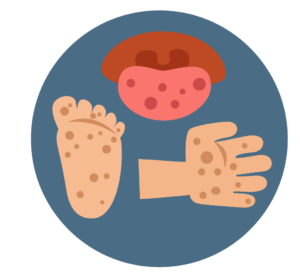 300x276 Hand Foot And Mouth Disease