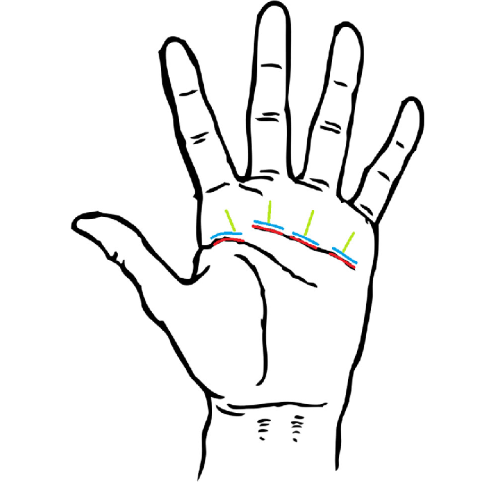 714x716 Schematic Drawing Of The Three Different Incision Techniques Used