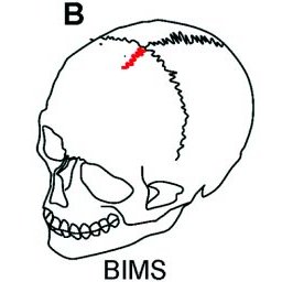 256x256 Schematic Drawing Of Three Different Metopic Sutures On Skulls