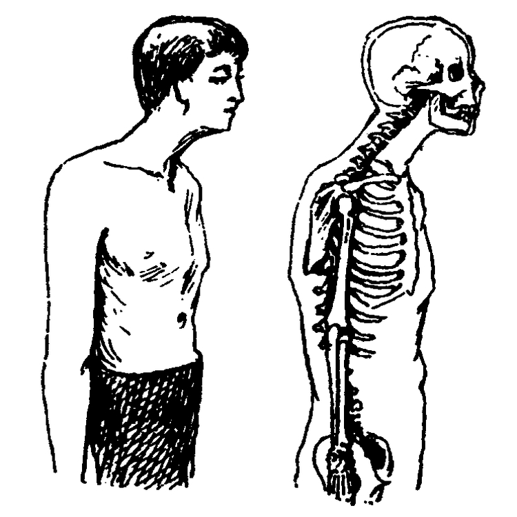 750x750 Common Postural Impairments