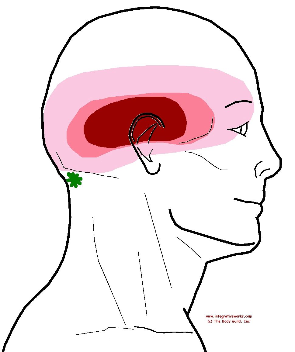 970x1158 understanding trigger points headache all over or in a band