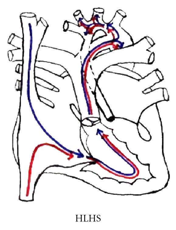 579x759 Impact Of Congenital Heart Disease On Brain Development