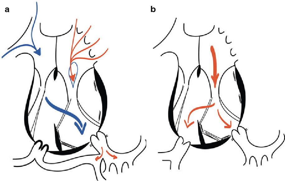 916x582 the tricuspid valve in congenital heart disease