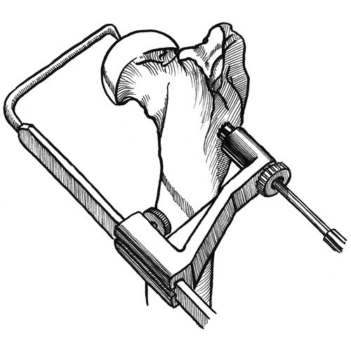 500x500 hip luxation starter kit