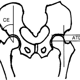 320x320 Schematic Drawing Showing The Ce Angle