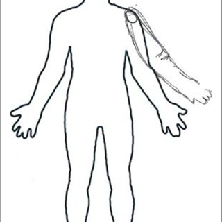 320x320 Drawing Of The Supernumerary Phantom Limb