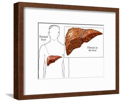400x335 biomedical illustration of cirrhosis or fibrosis of the human