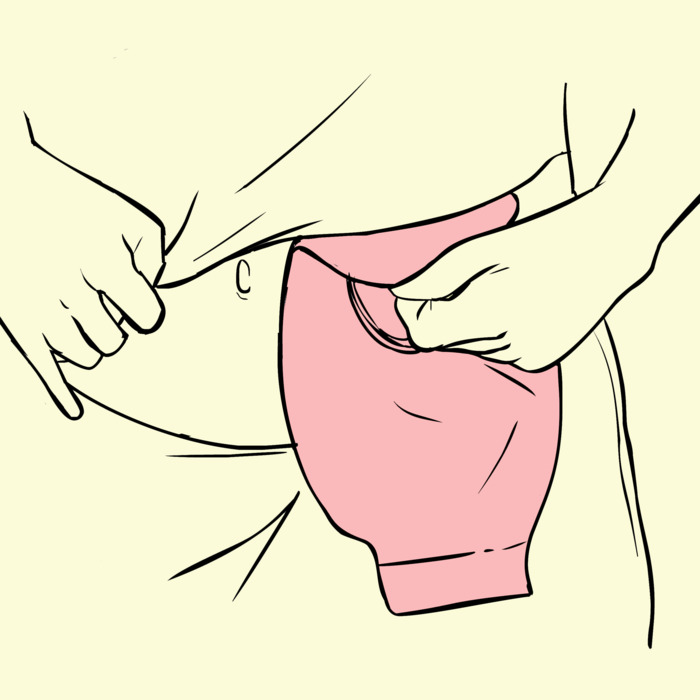 700x700 Living With A Stoma And A Colostomy Bag