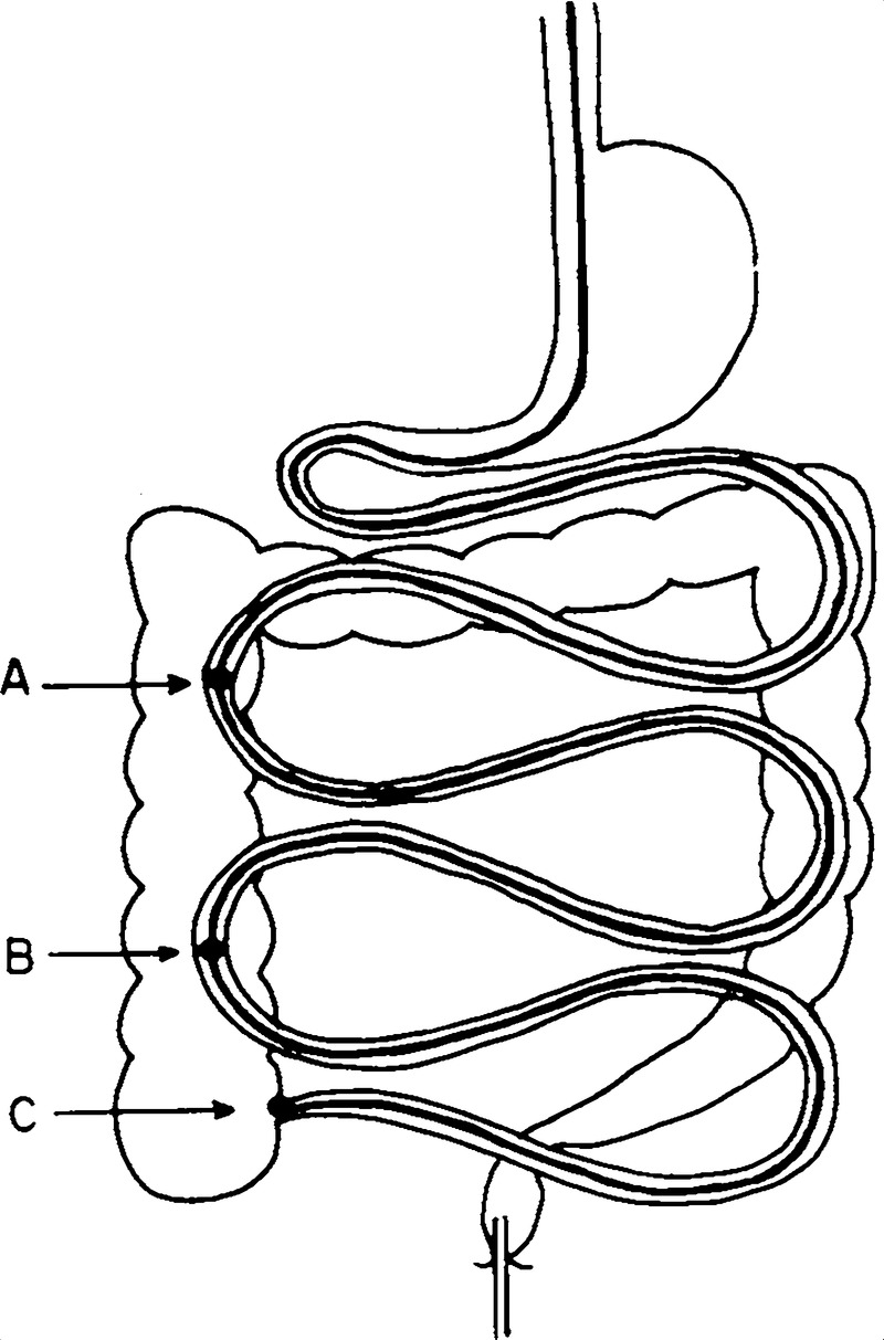 800x1213 production and excretion of hydrogen gas in man nejm